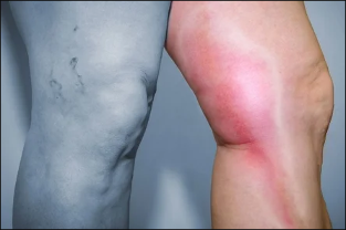 Agudo tromboflebitis de las venas superficiales